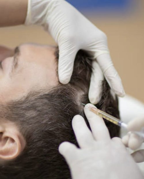 PRP for hair loss at Lotus Health & Aesthetica