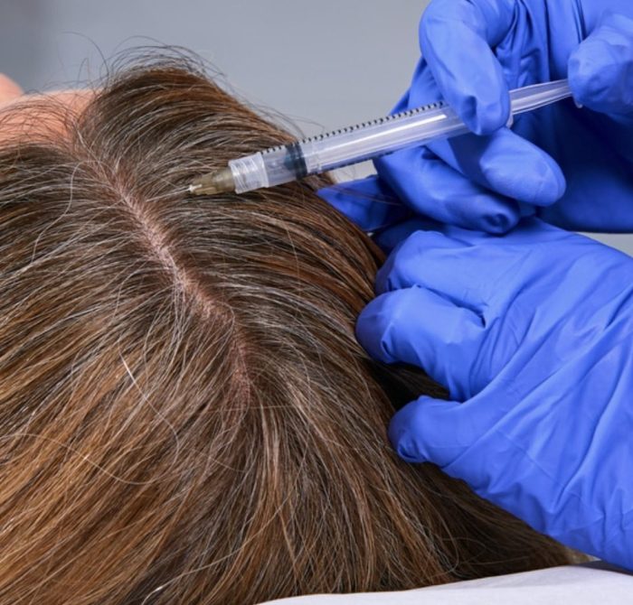 PRP for hair restoration at Lotus Health & Aesthetics
